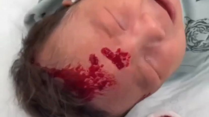 Нәрестеге хиджама жасаған емші көпшіліктің ашуын туғызды