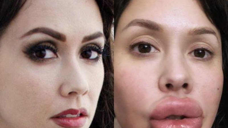 Таразда білімі жоқ "дәрігерлер" пластикалық ота жасаған